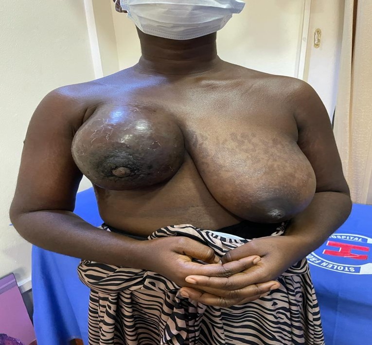 Clinical photograph of a patient with advanced-stage breast cancer (anonymised)