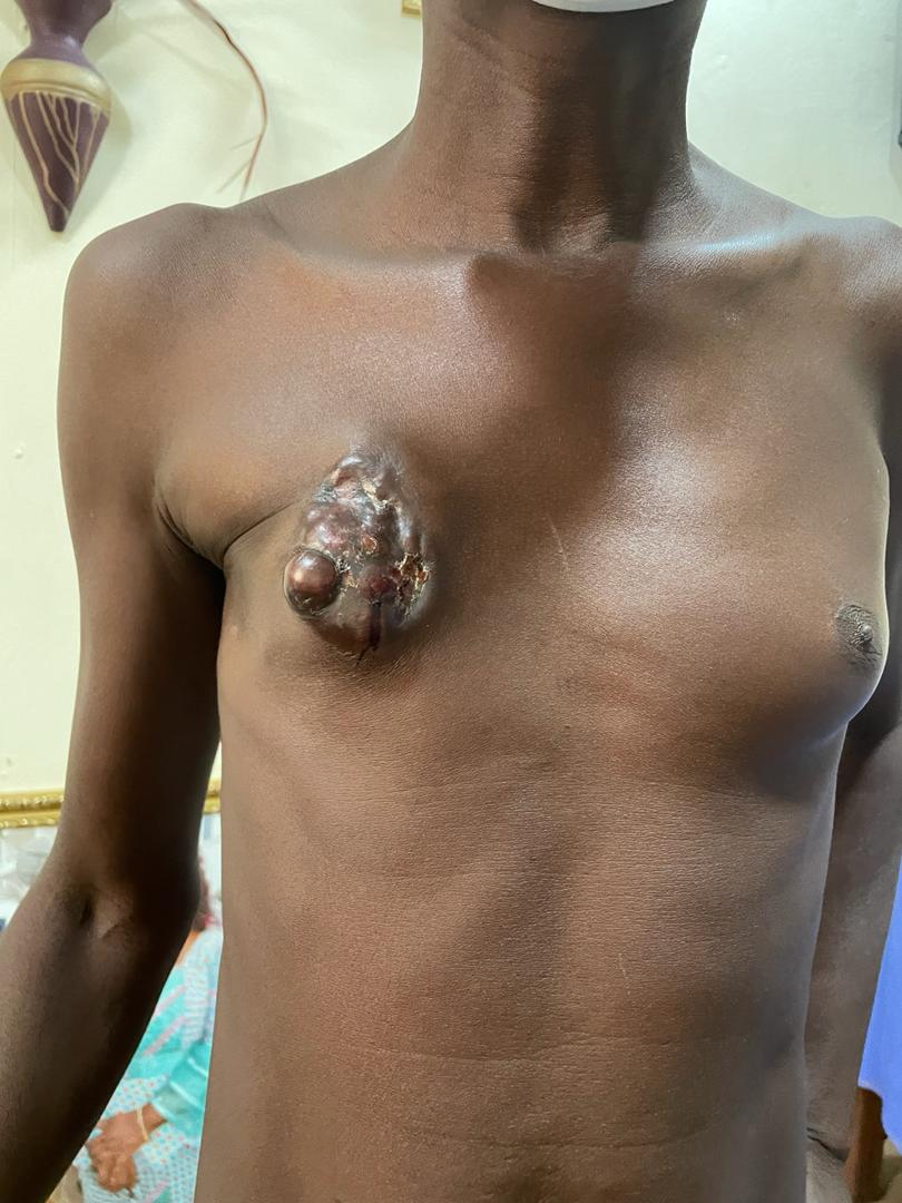 Clinical photograph of a young patient with an advanced breast tumour (anonymised)